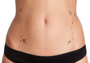 Shape Up Your Body with Vaser Liposuction